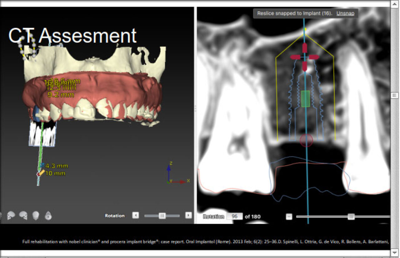 Single Implant Placement in the Upper Jaw Non-Esthetic Indication