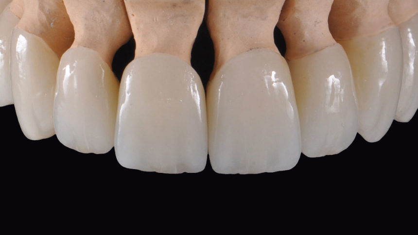 Προσθετικές στρατηγικές σε αποκαταστάσεις στηριζόμενες σε φυσικά δόντια - Εκπαιδευτής: Giacomo Fabbri