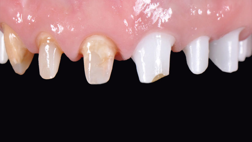 Προσθετικές στρατηγικές σε αποκαταστάσεις στηριζόμενες σε φυσικά δόντια - Εκπαιδευτής: Giacomo Fabbri