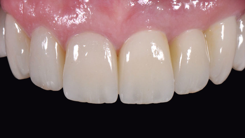 Προσθετικές στρατηγικές σε αποκαταστάσεις στηριζόμενες σε φυσικά δόντια - Εκπαιδευτής: Giacomo Fabbri