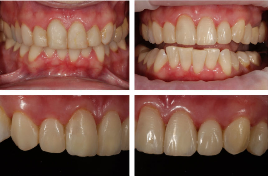 Σεμινάριο εκτεταμένων άμεσων αποκαταστάσεων σύνθετης ρητίνης Driving composite resins to their limits