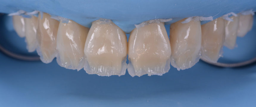 Ολοήμερο πρακτικό σεμινάριο άμεσων προσθίων αποκαταστάσεων με έμφαση στη μορφολογία και στη χρωματοληψία - Εκπαιδευτής: Tony Rotondo