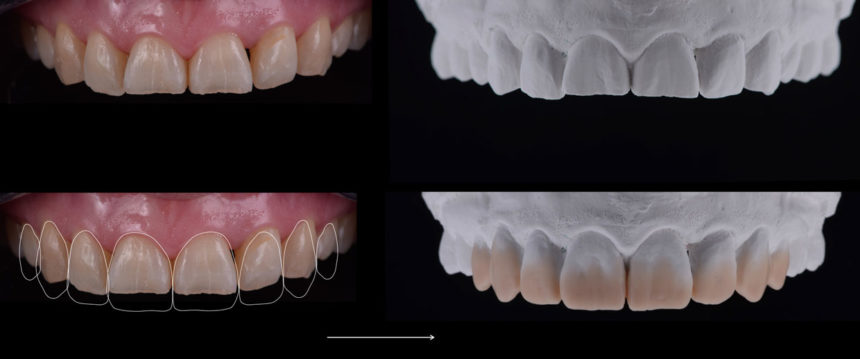Ολοήμερο πρακτικό σεμινάριο άμεσων προσθίων αποκαταστάσεων με έμφαση στη μορφολογία και στη χρωματοληψία - Εκπαιδευτής: Tony Rotondo