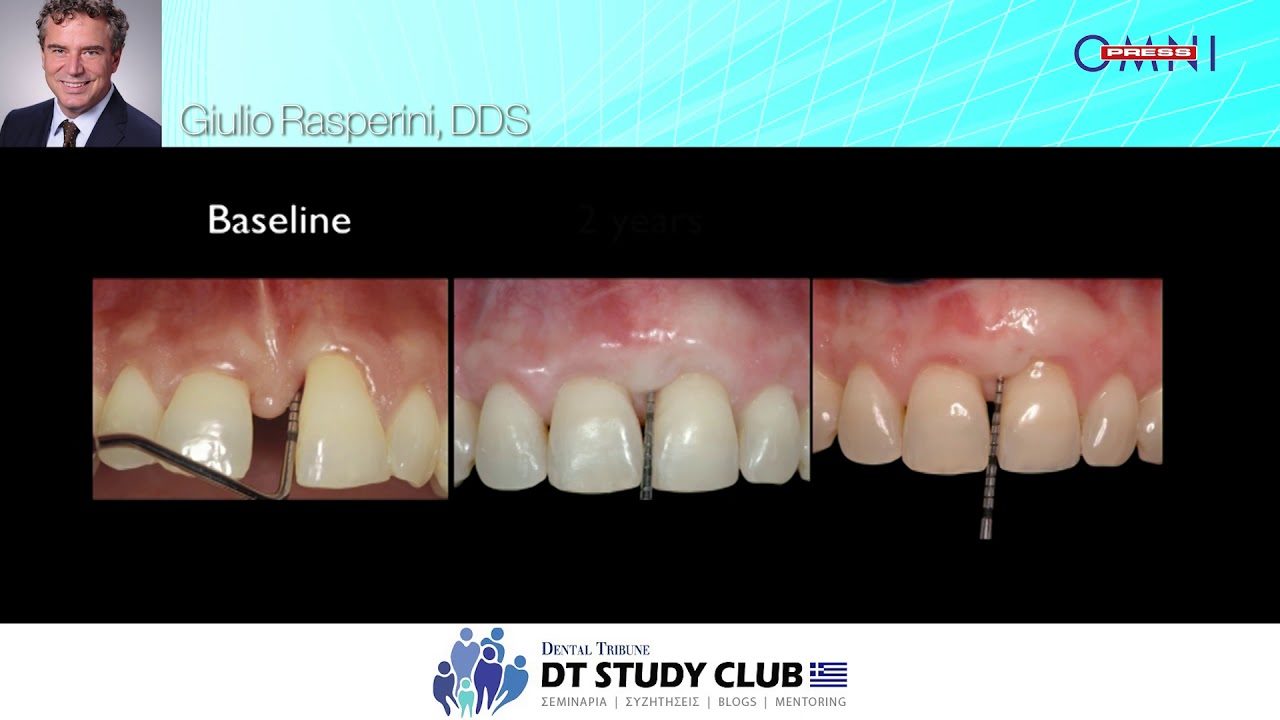 Surgical techniques and biomaterials in periodontal plastic surgery