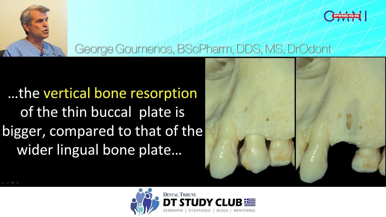 Soft tissue management in Esthetic Implantology