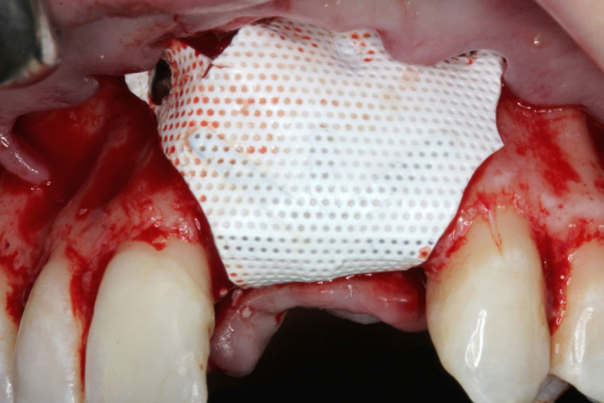 Κάθετη και οριζόντια αύξηση των σκληρών και μαλακών ιστών με τη χρήση κατευθυνόμενης οστικής αναγέννησης (GBR) - Εκπαιδευτής: Sascha Jovanovic