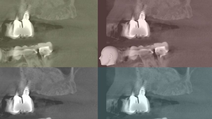 Κάθετη και οριζόντια αύξηση των σκληρών και μαλακών ιστών με τη χρήση κατευθυνόμενης οστικής αναγέννησης (GBR) - Εκπαιδευτής: Sascha Jovanovic