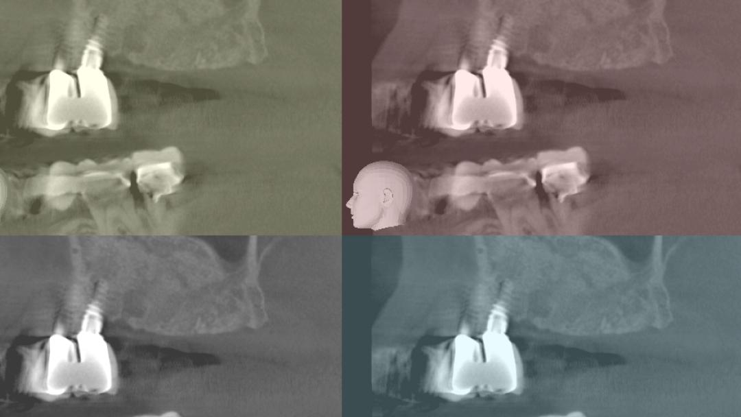 Κάθετη και οριζόντια αύξηση των σκληρών και μαλακών ιστών με τη χρήση κατευθυνόμενης οστικής αναγέννησης (GBR) - Εκπαιδευτής: Sascha Jovanovic