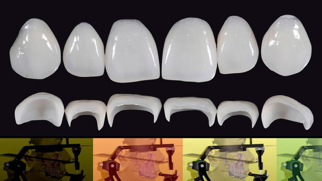 Προσθετικές στρατηγικές σε αποκαταστάσεις στηριζόμενες σε φυσικά δόντια - Εκπαιδευτής: Giacomo Fabbri