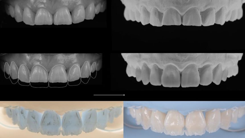 Ολοήμερο πρακτικό σεμινάριο άμεσων προσθίων αποκαταστάσεων με έμφαση στη μορφολογία και στη χρωματοληψία - Εκπαιδευτής: Tony Rotondo