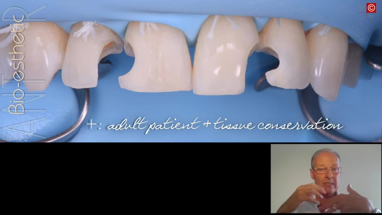 Bio-Esthetics with Freehand Bonding 2.0