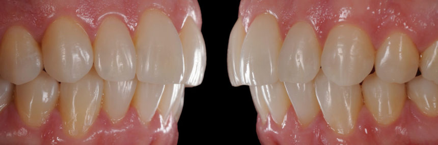 Ολοήμερο πρακτικό σεμινάριο άμεσων προσθίων αποκαταστάσεων με έμφαση στη μορφολογία και στη χρωματοληψία - Εκπαιδευτής: Tony Rotondo